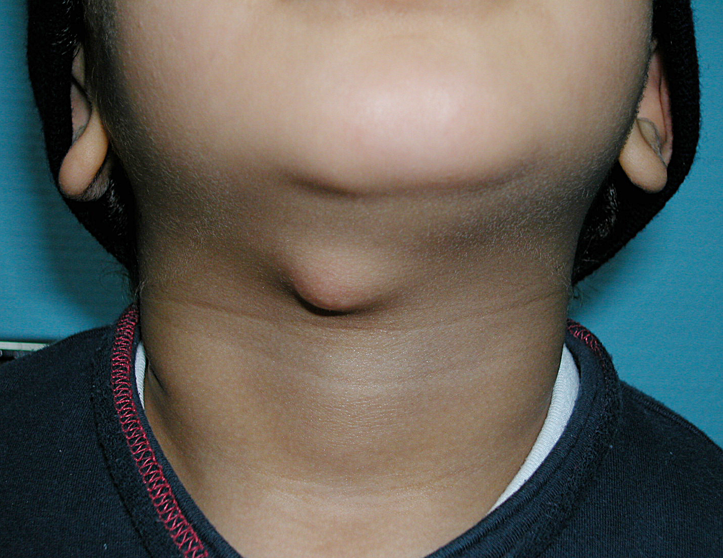 Thyroglossal-Duct-Cyst